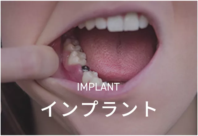 implant