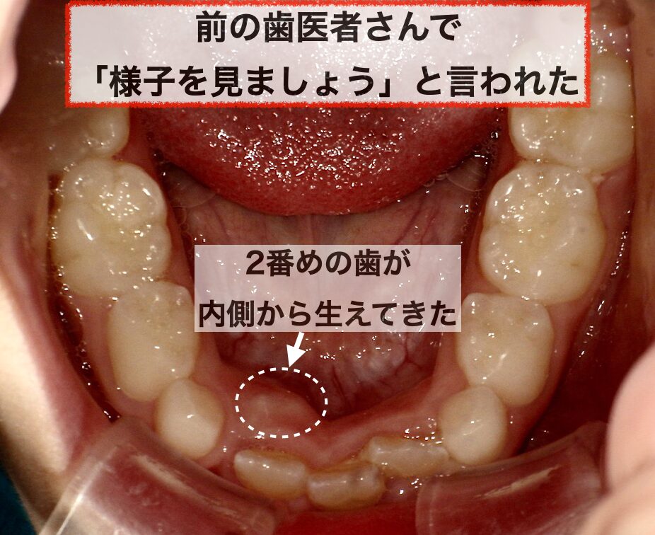 上あごと下あごの成長時期の違い | 高槻市の歯医者なら「くろおかファミリー歯科」