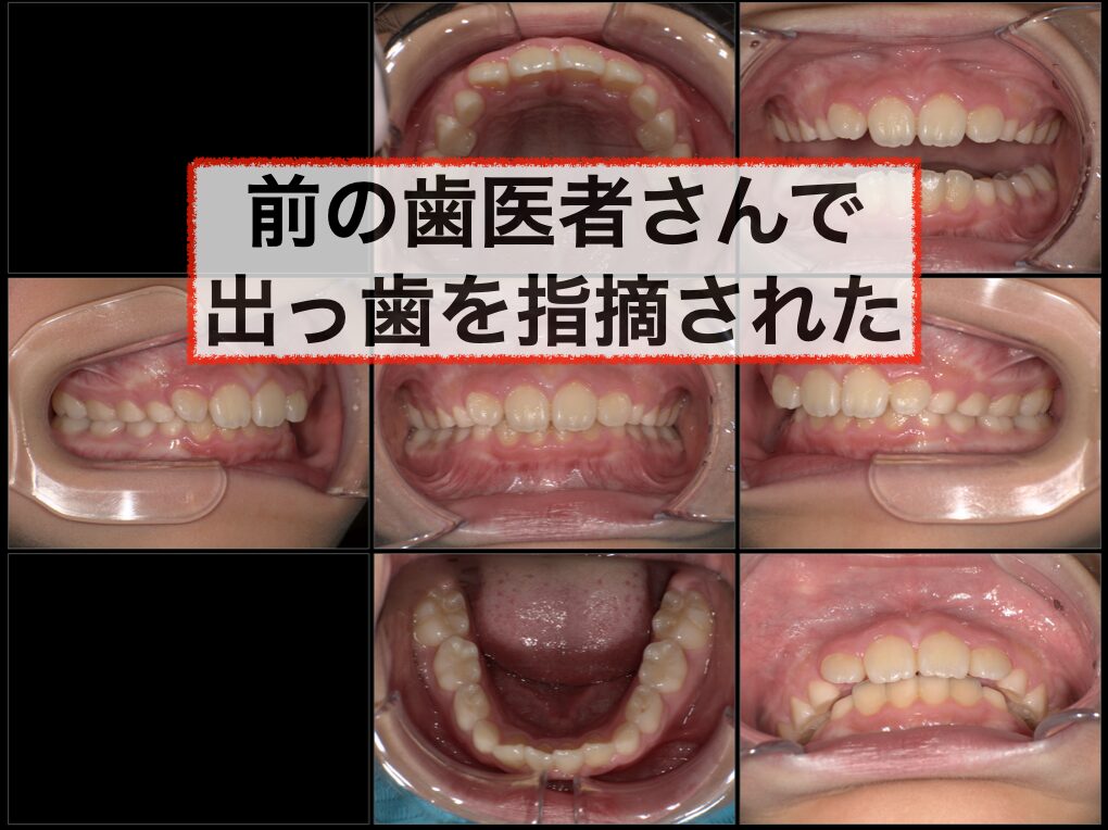 上あごと下あごの成長時期の違い | 高槻市の歯医者なら「くろおかファミリー歯科」