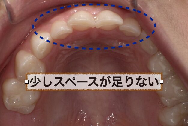 上あごと下あごの成長時期の違い | 高槻市の歯医者なら「くろおかファミリー歯科」