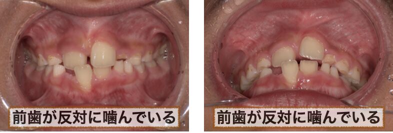 口腔内写真