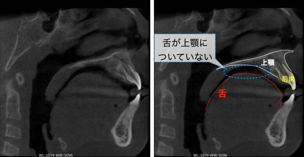 低位舌のCT画像