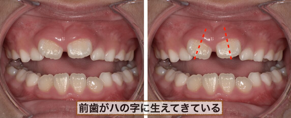前歯がハの字になっている写真