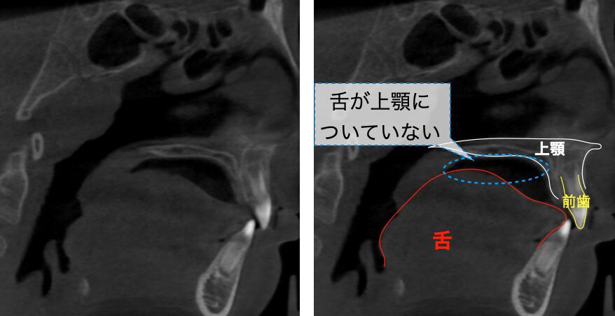 低舌位のCT画像