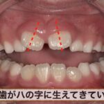 前歯がハの字に生えている写真