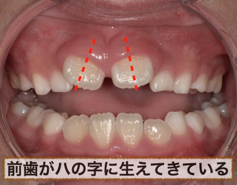 前歯がハの字に生えている写真