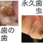 乳歯と永久歯の見た目の違いの写真