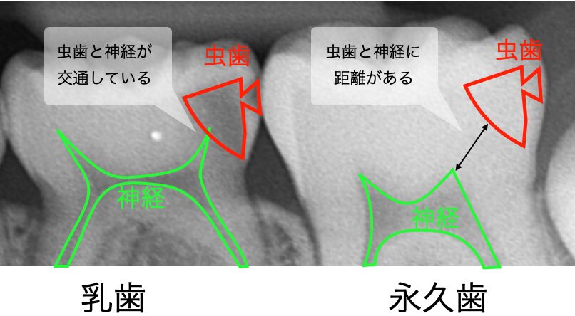 乳歯と永久歯に同じ大きさの虫歯ができたとした時のレントゲン写真