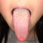 舌苔の写真