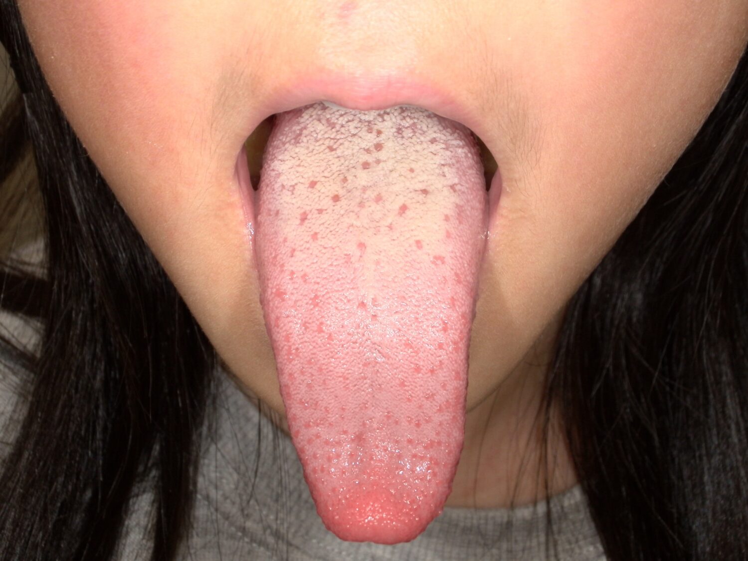 舌苔の写真