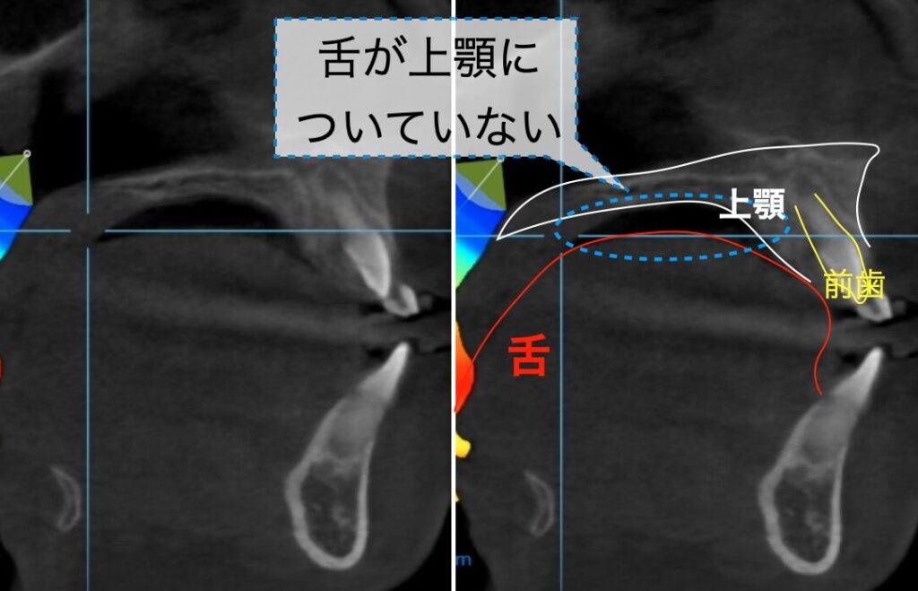 低舌位のCT画像