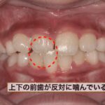 反対咬合の口腔内写真