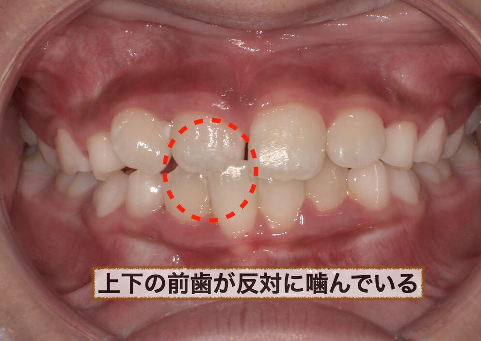 反対咬合の口腔内写真
