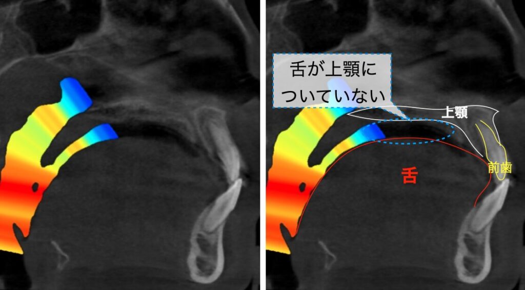低舌位のCT画像
