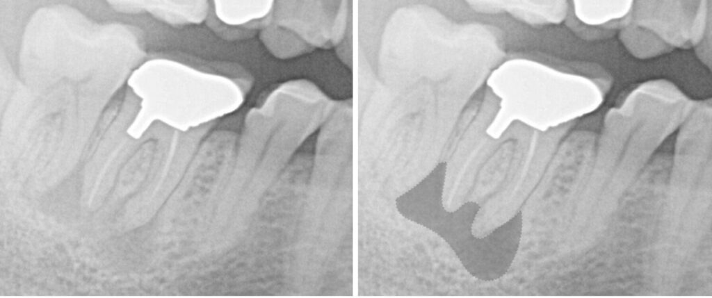 抜歯が必要と言われた歯の根の感染