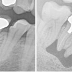 抜歯が必要と言われた歯のレントゲン
