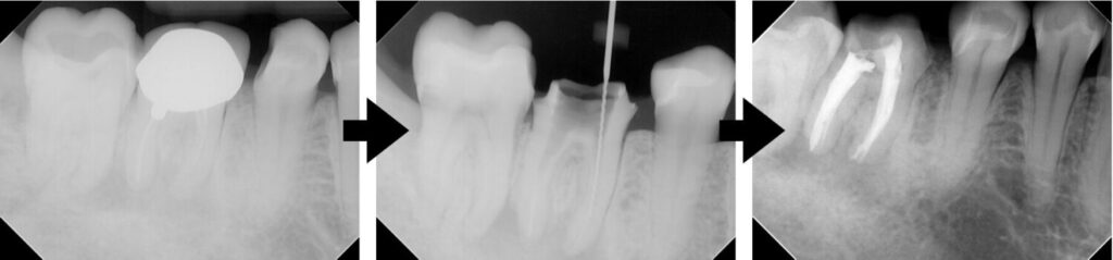 歯の根の治療の経過