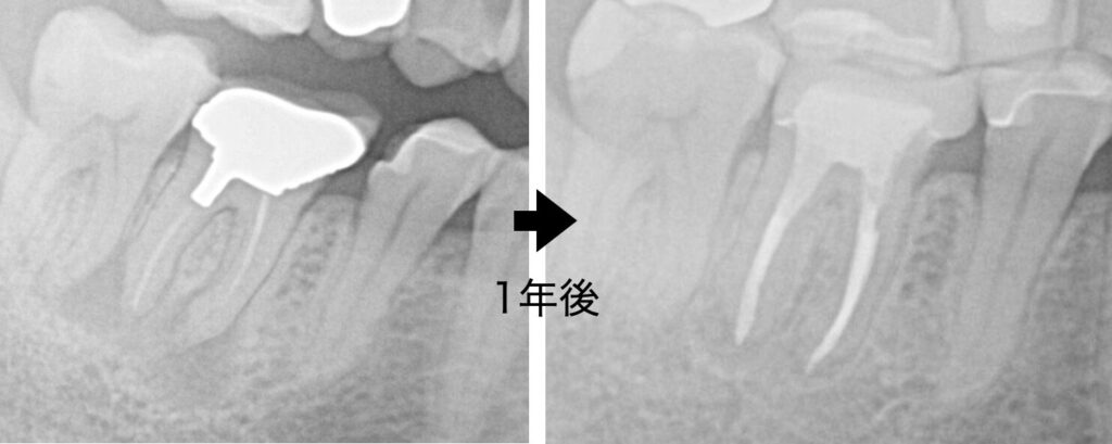 抜かないといけないと言われた歯が治癒したレントゲン写真