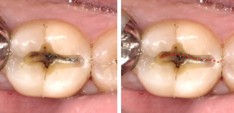 歯が割れている写真
