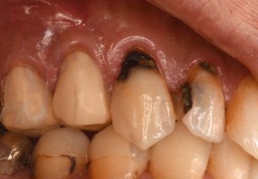 虫歯の写真