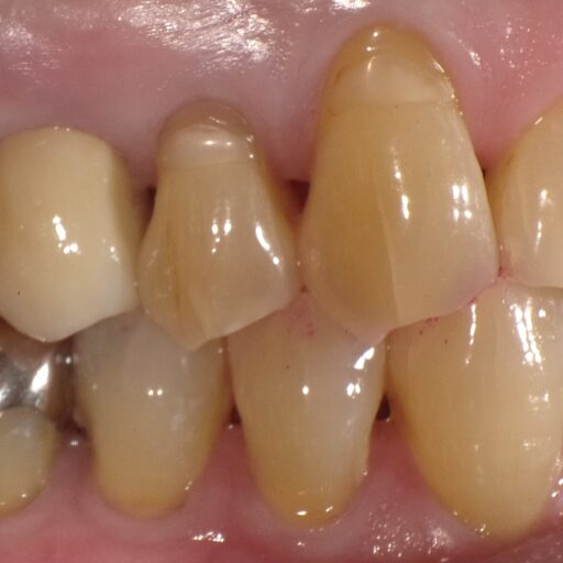 知覚過敏のある歯の写真