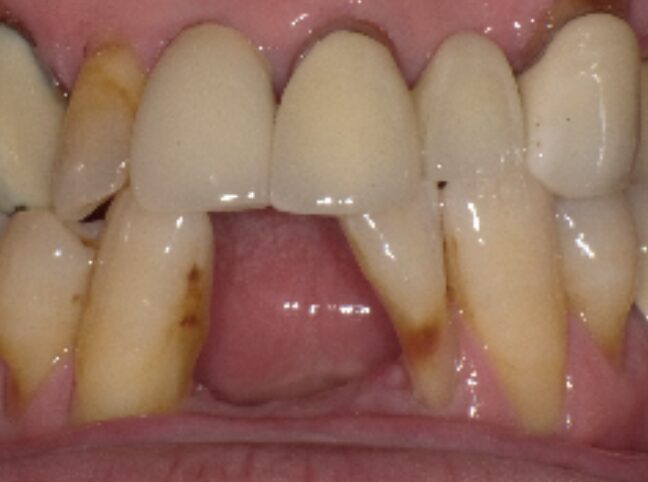歯周病の写真