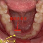 歯が生えるスペースが足りない写真