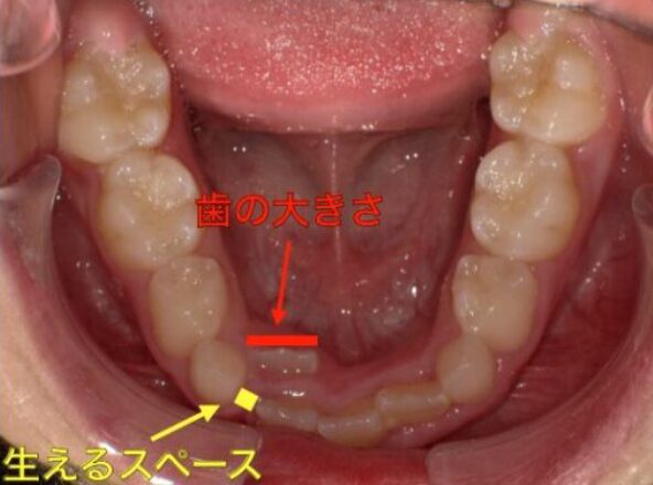 歯が生えるスペースが足りない写真