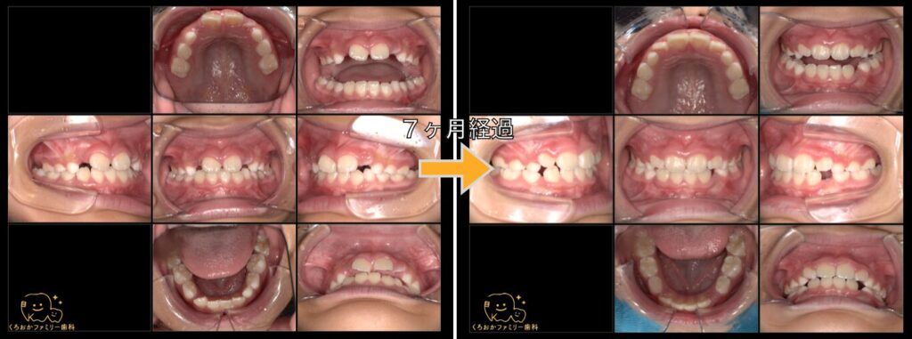 小児矯正治療７ヶ月経過比較写真