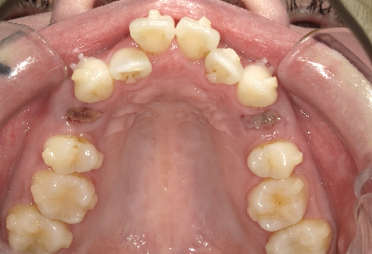 抜歯矯正時の抜歯部位の写真