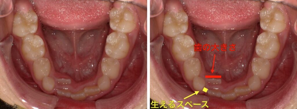 歯の生えるスペースが足りない写真
