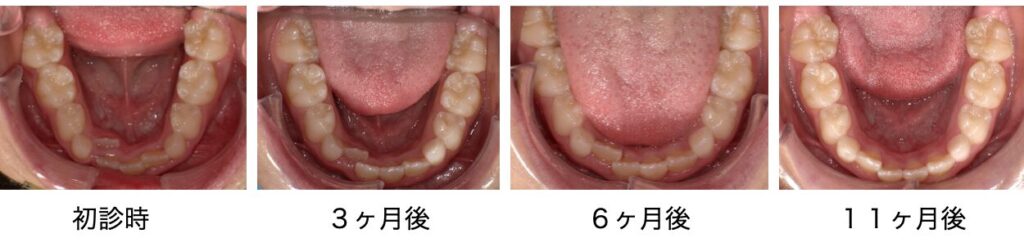 小児矯正治療の治療経過の写真