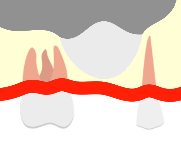 上顎洞に人工骨を移植したイラスト