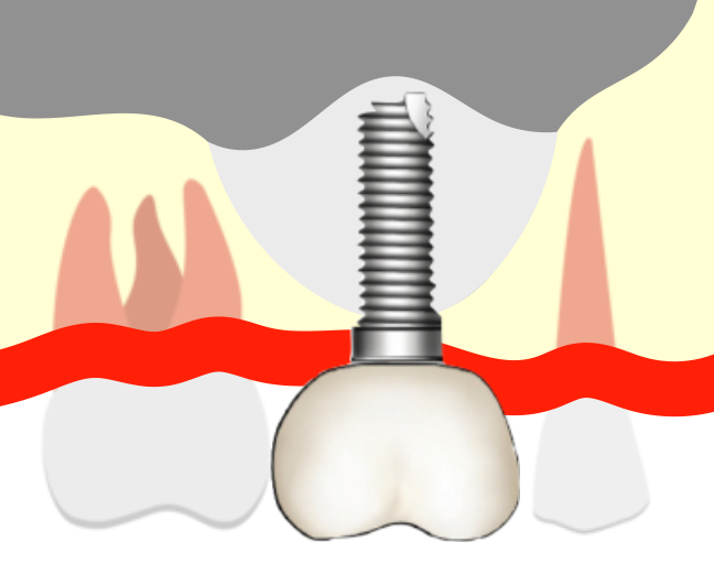 ソケットリフト後にインプラント埋入したイラスト
