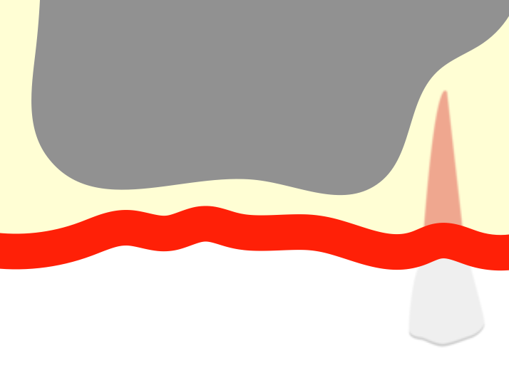 既存骨が少ないイラスト