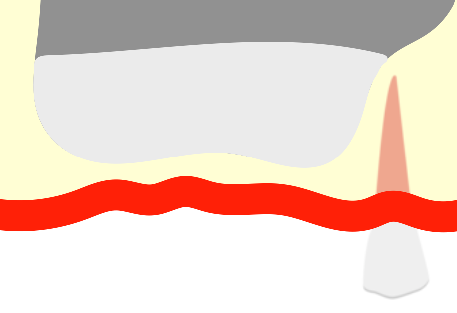 サイナスリフトで人工骨移植したイラスト