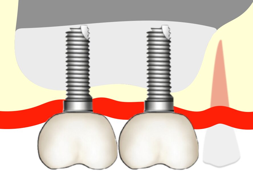 サイナスリフト後にインプラント埋入したイラスト