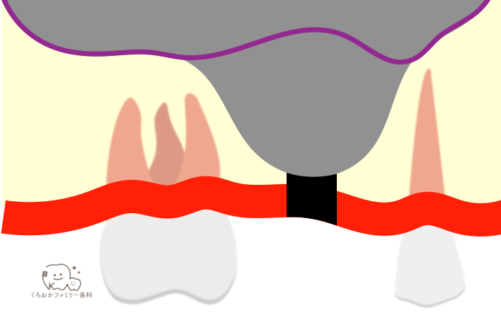 埋入窩からシュナイダー膜を挙上したイラスト
