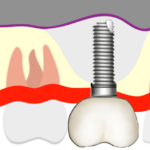 グラフトレスソケットリフトのイラスト