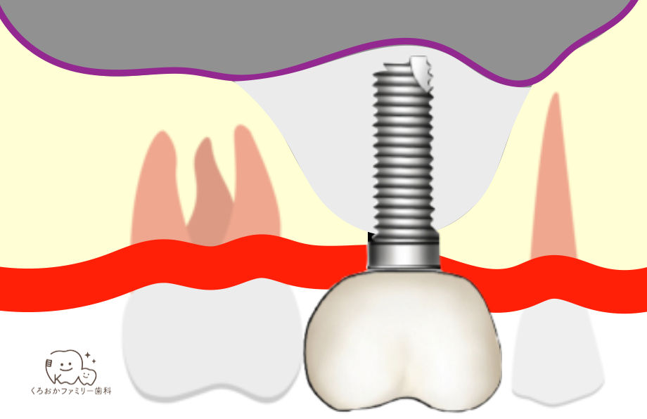 グラフトレスソケットリフトのイラスト