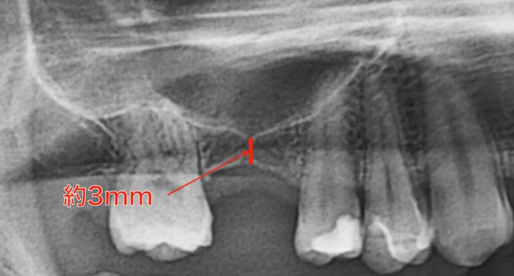 既存骨が少ないレントゲン
