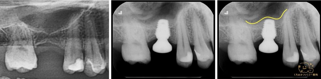 グラフトレスソケットリフトの実際のレントゲン
