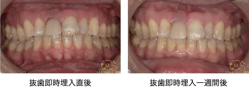 抜歯即時埋入一週間後の口腔内写真