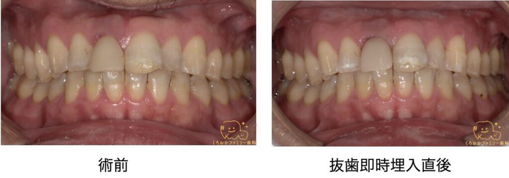 抜歯即時埋入時の口腔内写真
