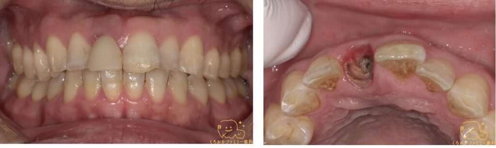 上顎前歯部の写真