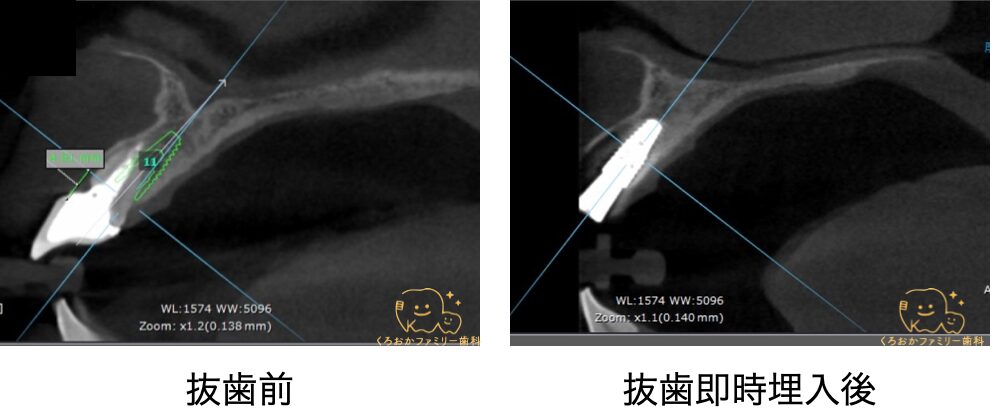 抜歯即時埋入時のCT画像