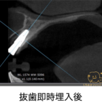 抜歯即時埋入時のCT画像