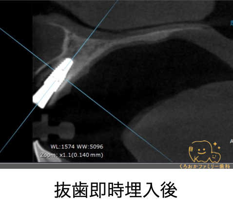 抜歯即時埋入時のCT画像