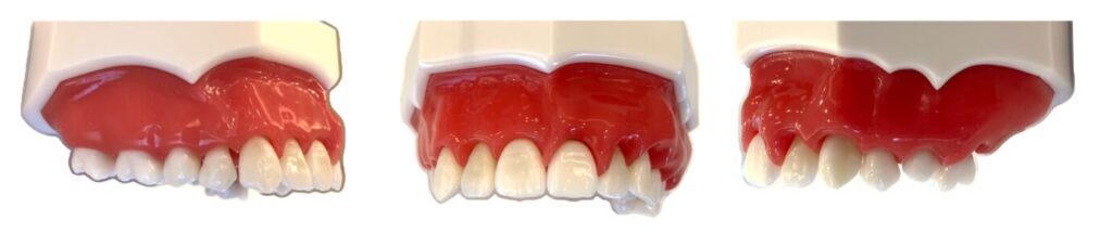 歯の模型の写真