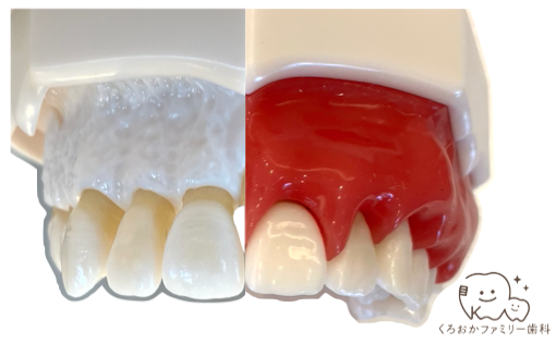 歯茎の中には骨があることがわかる写真